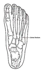 Jones 5th Metatarsal Fracture · Virtual Fracture Clinic